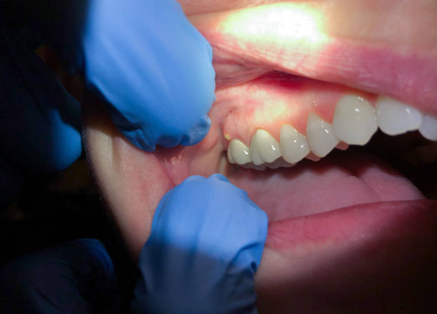 Best Emergency Wisdom Teeth Removal in Polk City, IA