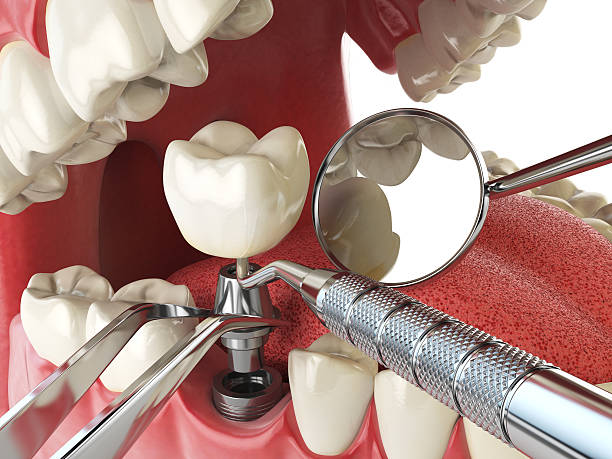 Best Emergency Broken Tooth Repair in Polk City, IA